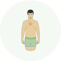 Высыпания на коже Высыпания на коже