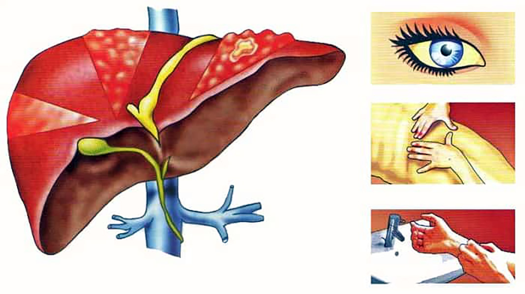 Профилактика гепатита С