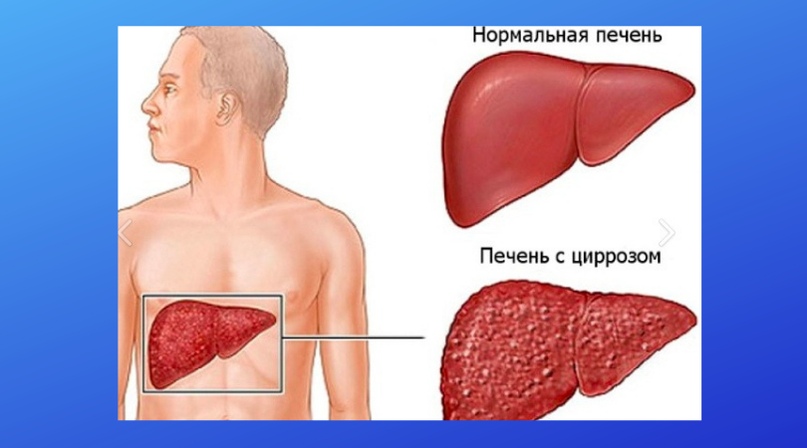 Профилактика цирроза печени при заражении вирусом гепатита С