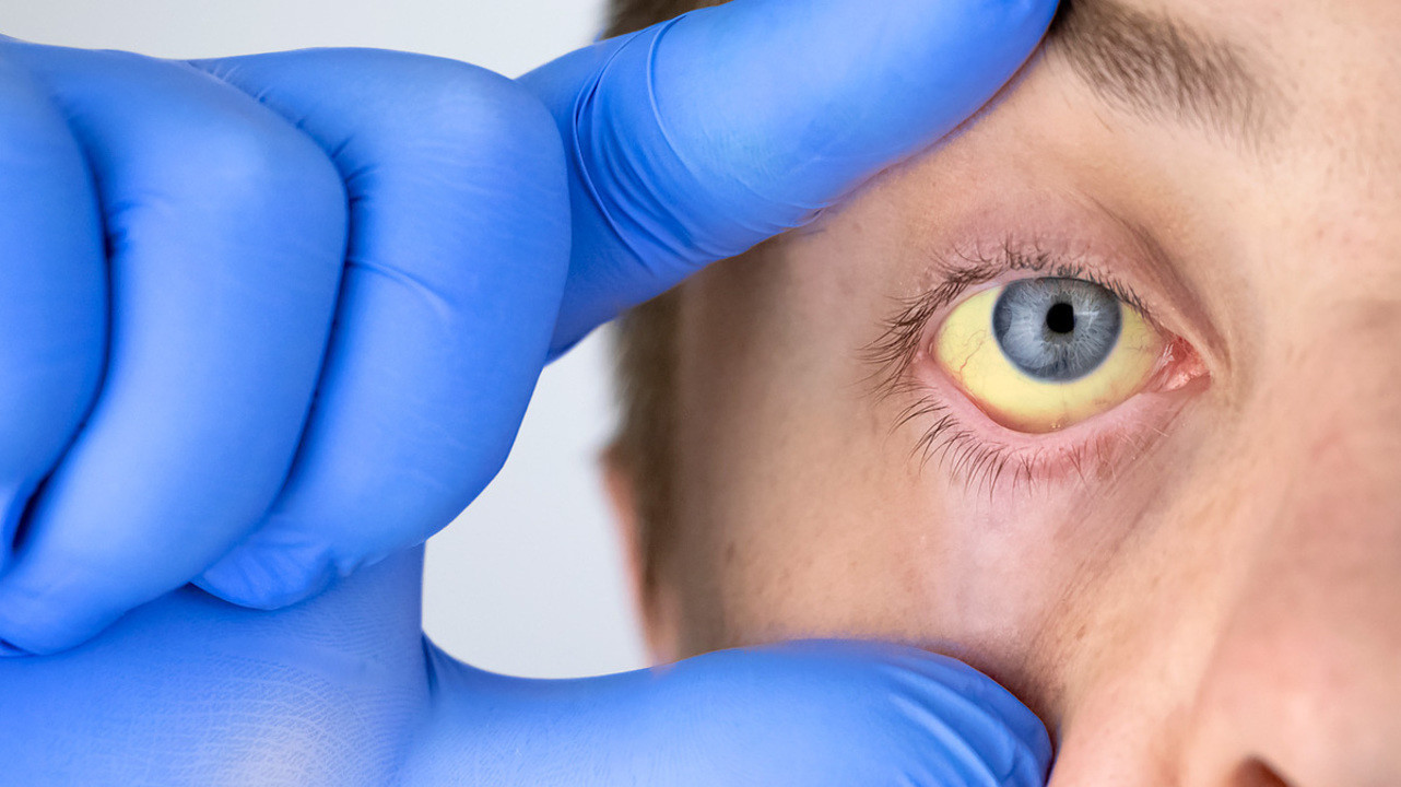 Симптоматика гепатита С